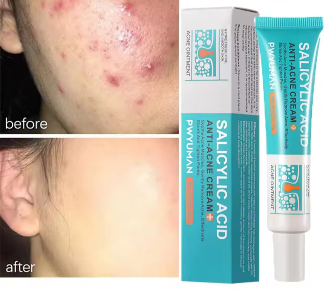 Crema Antiacné / Antiacne Cream